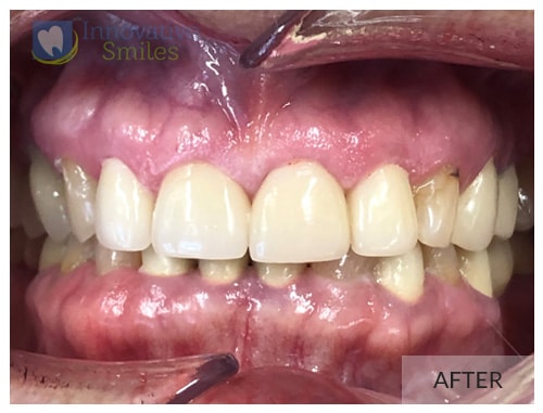 Dr. Jesmine Porcelain Veneers After 1A1