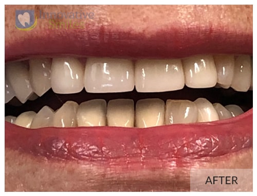 Dr. Jesmine Porcelain Veneers After 1B1