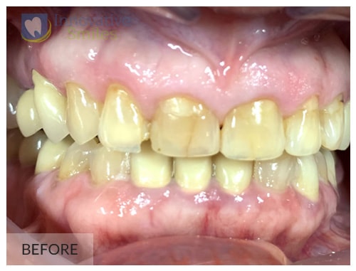 Dr. Jesmine Porcelain Veneers After 1A1