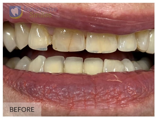 Dr. Jesmine Porcelain Veneers After 1B1