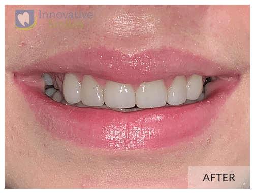 Porcelain Veneers After 1B