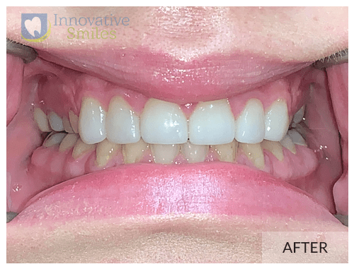 Upper Anterior Porcelain Veneers After 1A