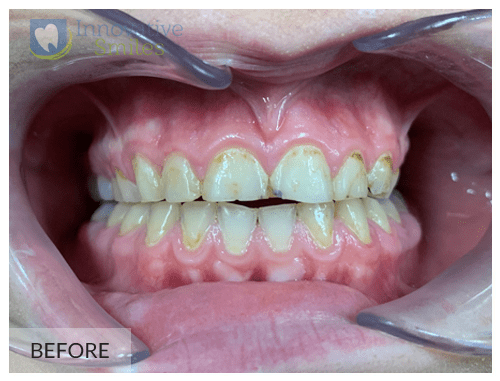 Upper Anterior Porcelain Veneers After 1A