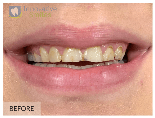 Porcelain Veneers After 1B