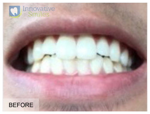 Veneers After 2