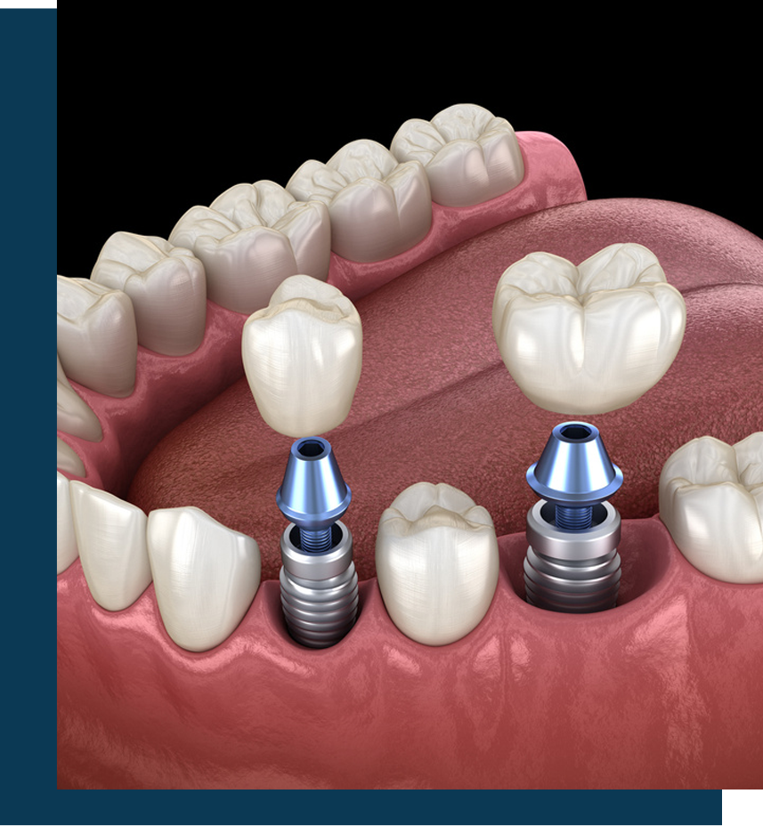 Graphical Image showing dental implants