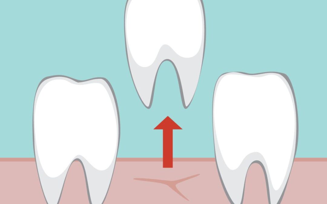 featured image for article about is a tooth extraction painful