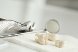 Wisdom Teeth Removal Long Beach, CA
