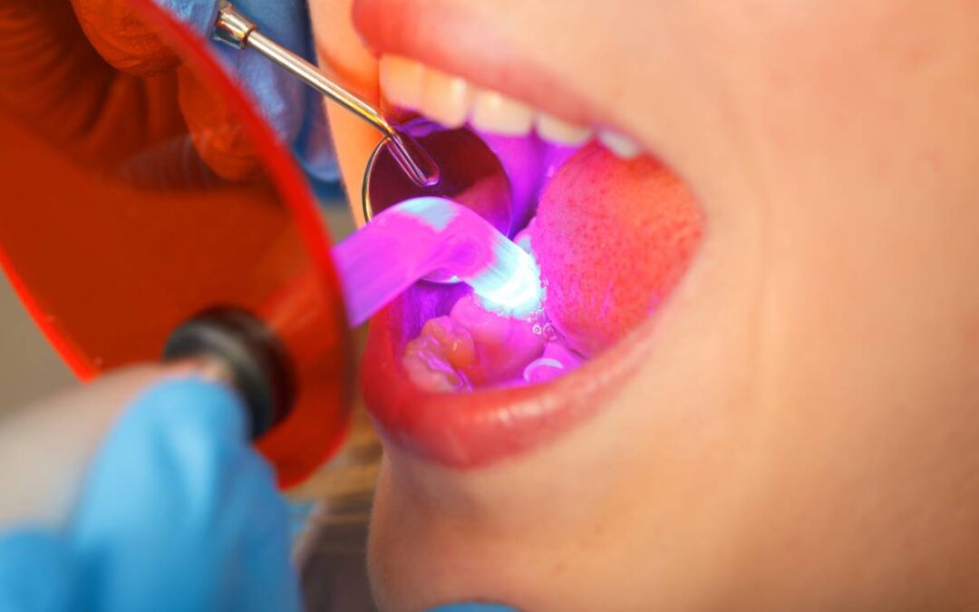 Featured image for How Long Does Dental Bonding Last?